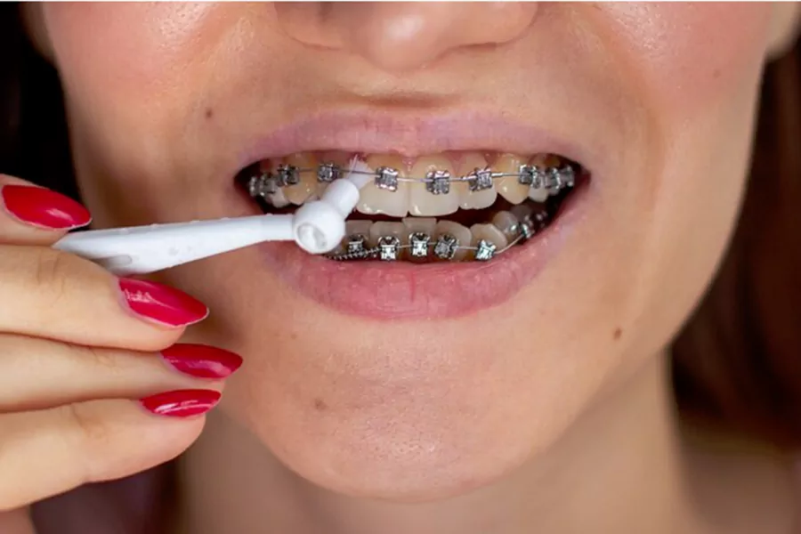 مراقبت‌های بعد از ارتودنسی