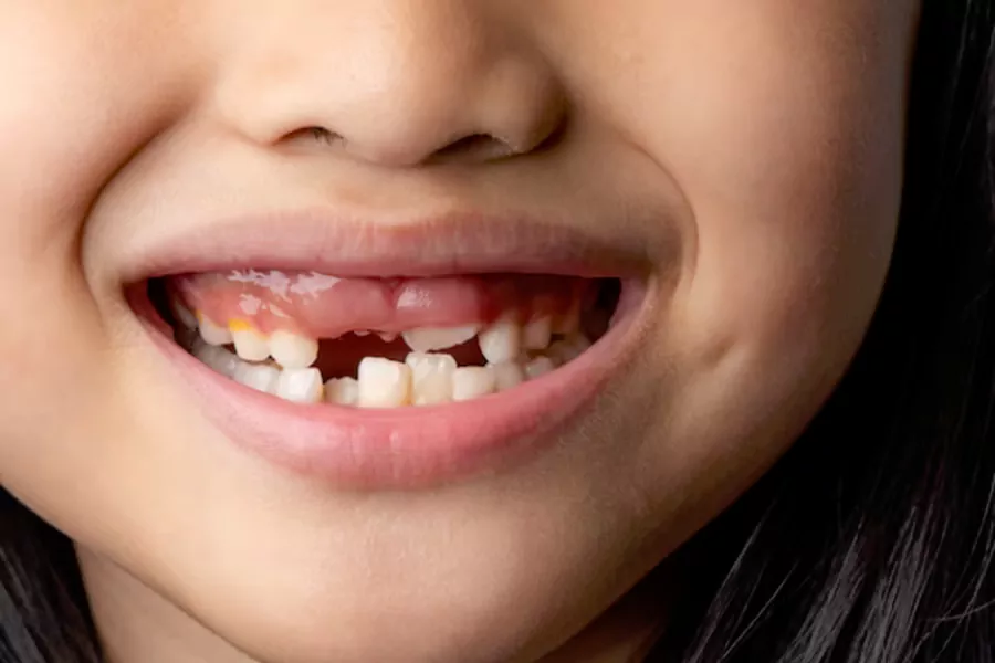 مناسب ترین سن برای کامپوزیت دندان