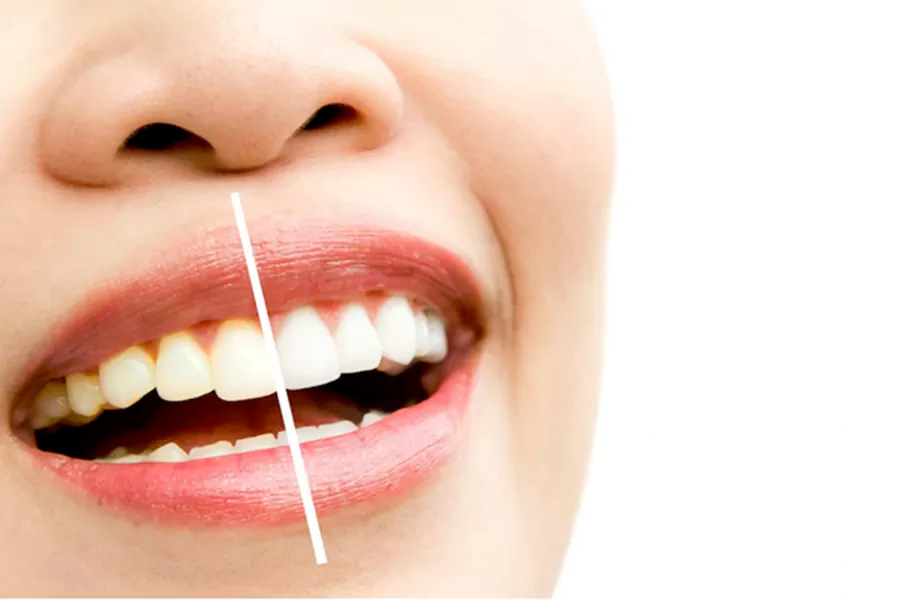 جلوگیری از زرد شدن کامپوزیت دندان