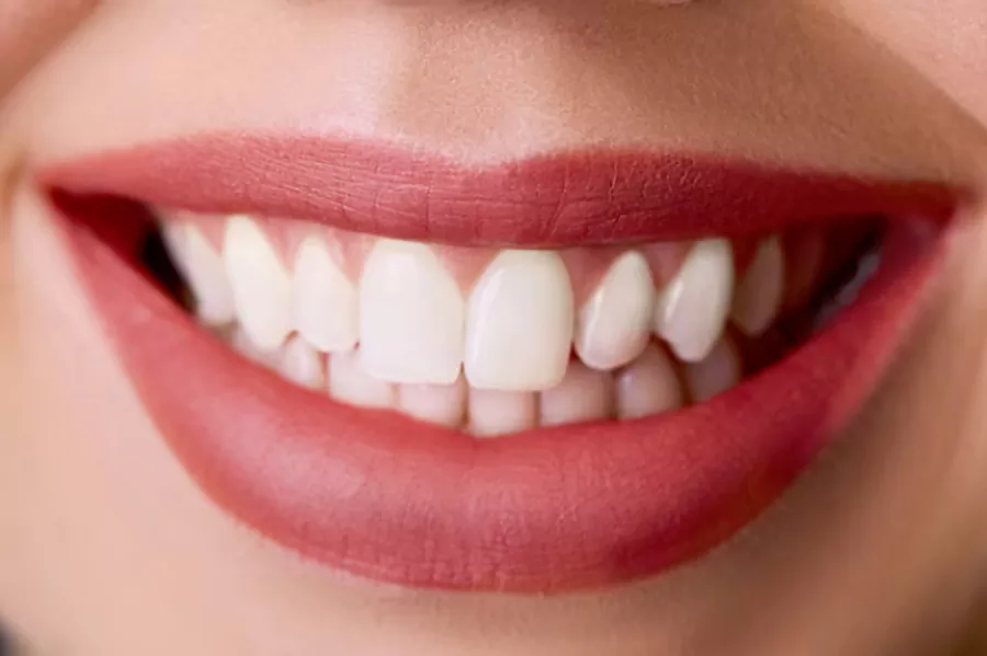 مراقبت های بعد از کامپوزیت دندان