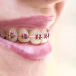 مدت زمان ارتودنسی چقدر است؟