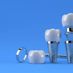 مراحل انجام ایمپلنت