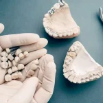 سن مناسب برای ایمپلنت دندان