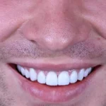 لومینیرز دندان