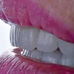 لمینت سرامیکی