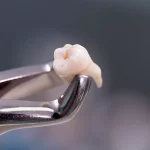 بهبودی دندان عقل پس از جراحی