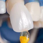 قیمت کامپوزیت دندان