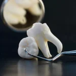 نکاتی که باید قبل از کشیدن دندان عقل بدانید