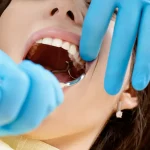 مراحل جراحی دندان عقل