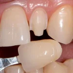 طول عمر لمینت دندان