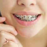 مزایا و معایب ارتودنسی