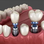 جنس ایمپلنت دندان