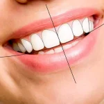 لمینت دندان برای چه کسانی مناسب است؟