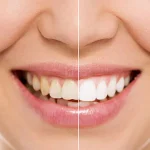 تفاوت کامپوزیت و ارتودنسی