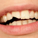 ترمیم دندان شکسته