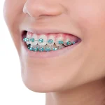 کش ارتودنسی