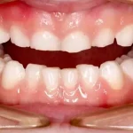 دندان قروچه