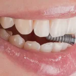 طول عمر ایمپلنت دندان