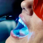 بلیچینگ دندان چقدر دوام دارد