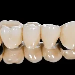 ایمپلنت سرامیکی