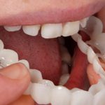 روکش دندان فوری