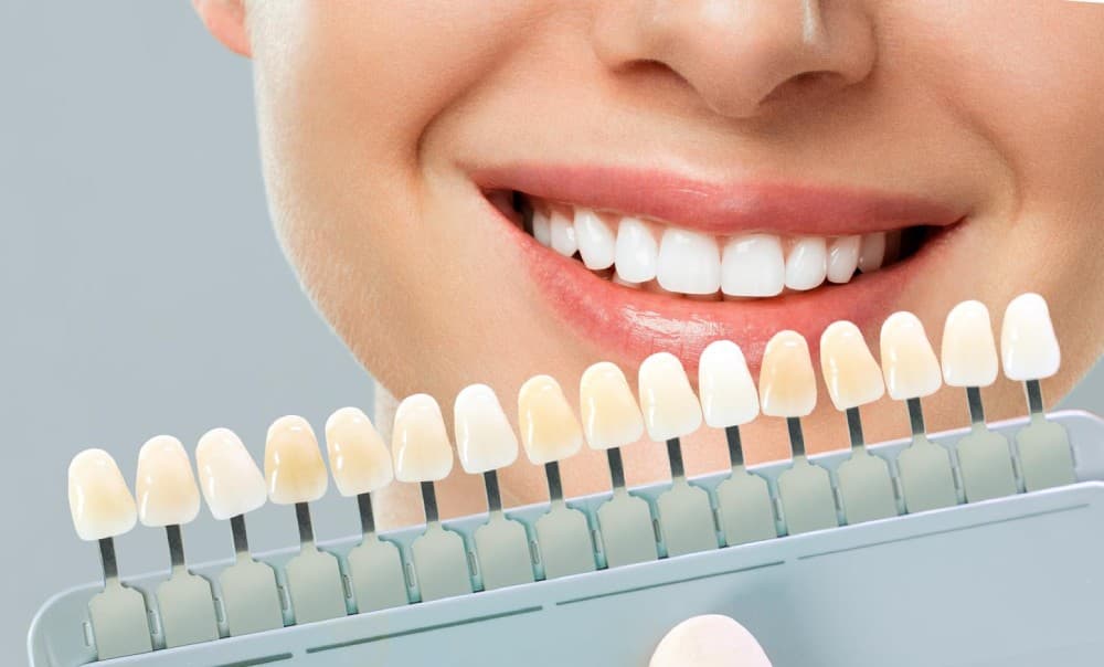 آیا میشود رنگ روکش دندان را تغییر داد؟