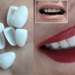 لمینت دندان برای زنان باردار چگونه انجام می‌شود؟