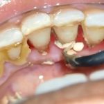 فواید جرم گیری دندان چیست؟